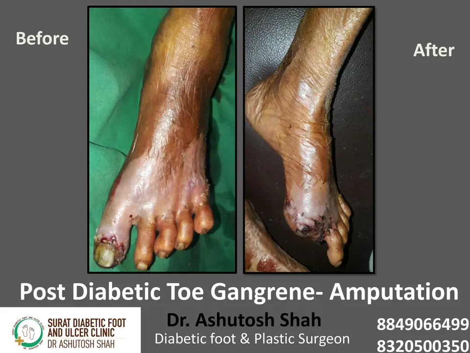 Gangrene and Amputation.pptx-7.webp